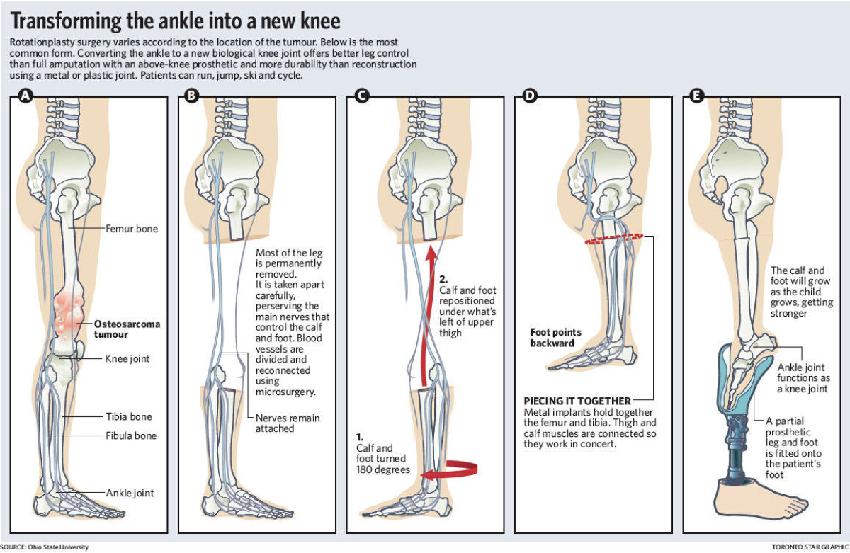 Leg type